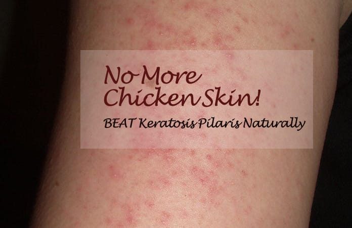 3 Effective Natural Remedies For Keratosis Pilaris & Other Problematic Skin Issues