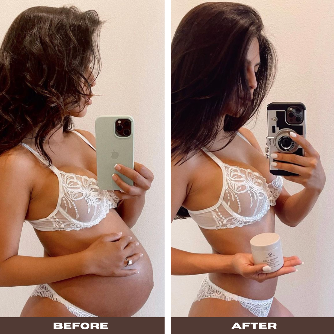 Stretchmark Prevention and Reduction During Pregnancy